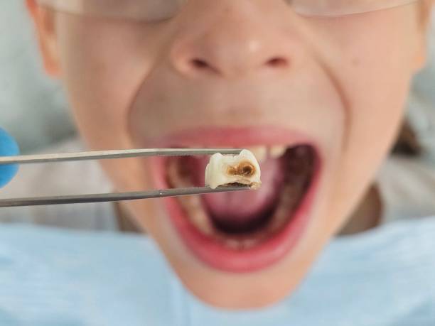 Best Emergency Treatment for Toothache in Centerville, CA